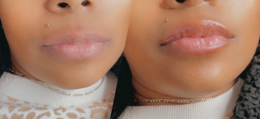 Hyaluronic Lip Fillers (Russian Effect)   PLEASE READ CONSENT FORMS PRIOR TO BOOKING (6 pages)